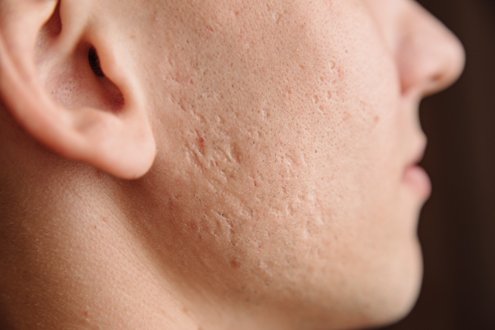 Article Solusi Ampuh Atasi Jerawat Bopeng Dengan 2 Rekomendasi Acne Scar Treatment yang Wajib Dicoba