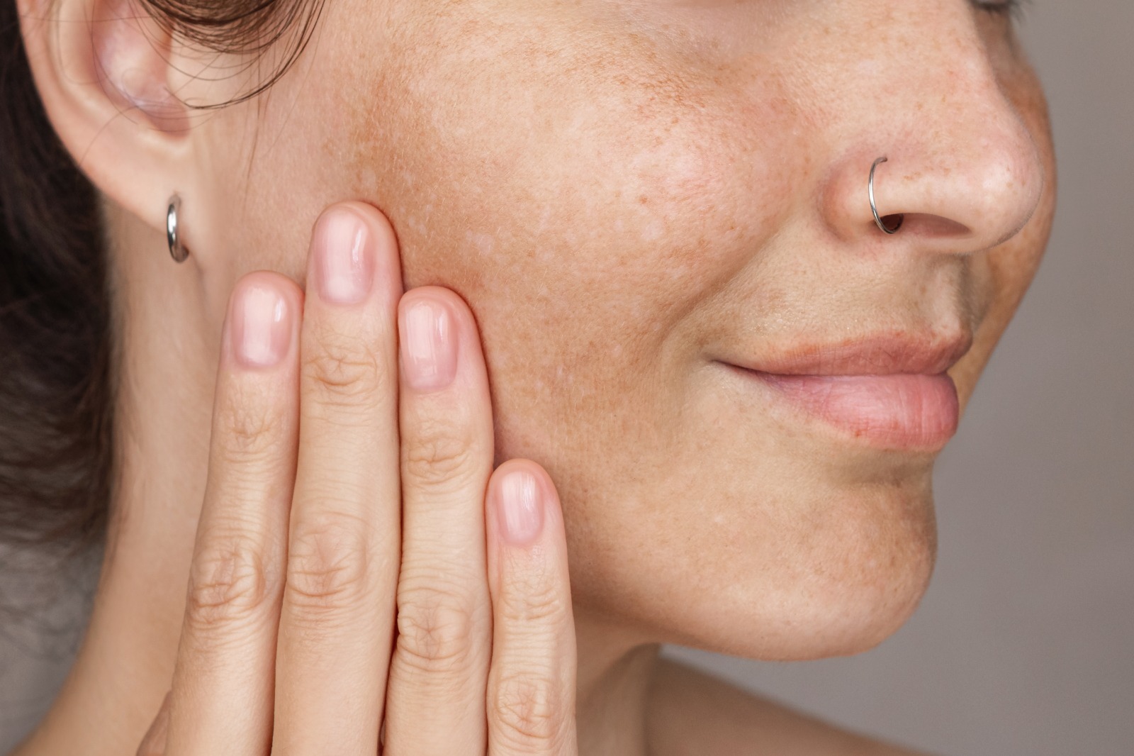 Article Tak Perlu Panik, Ini 3 Perawatan Klinik Kecantikan Terbaik untuk Hilangkan Dark Spot dengan Cepat