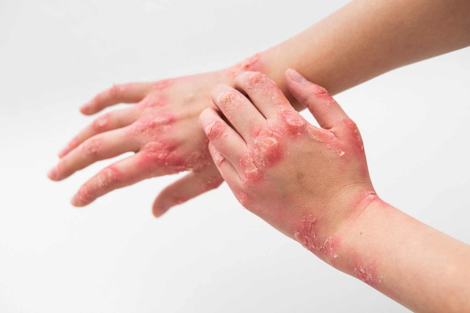 Article Eksim Tak Kunjung Sembuh? Coba Kombinasi Skincare Medis & NB UVB Therapy!