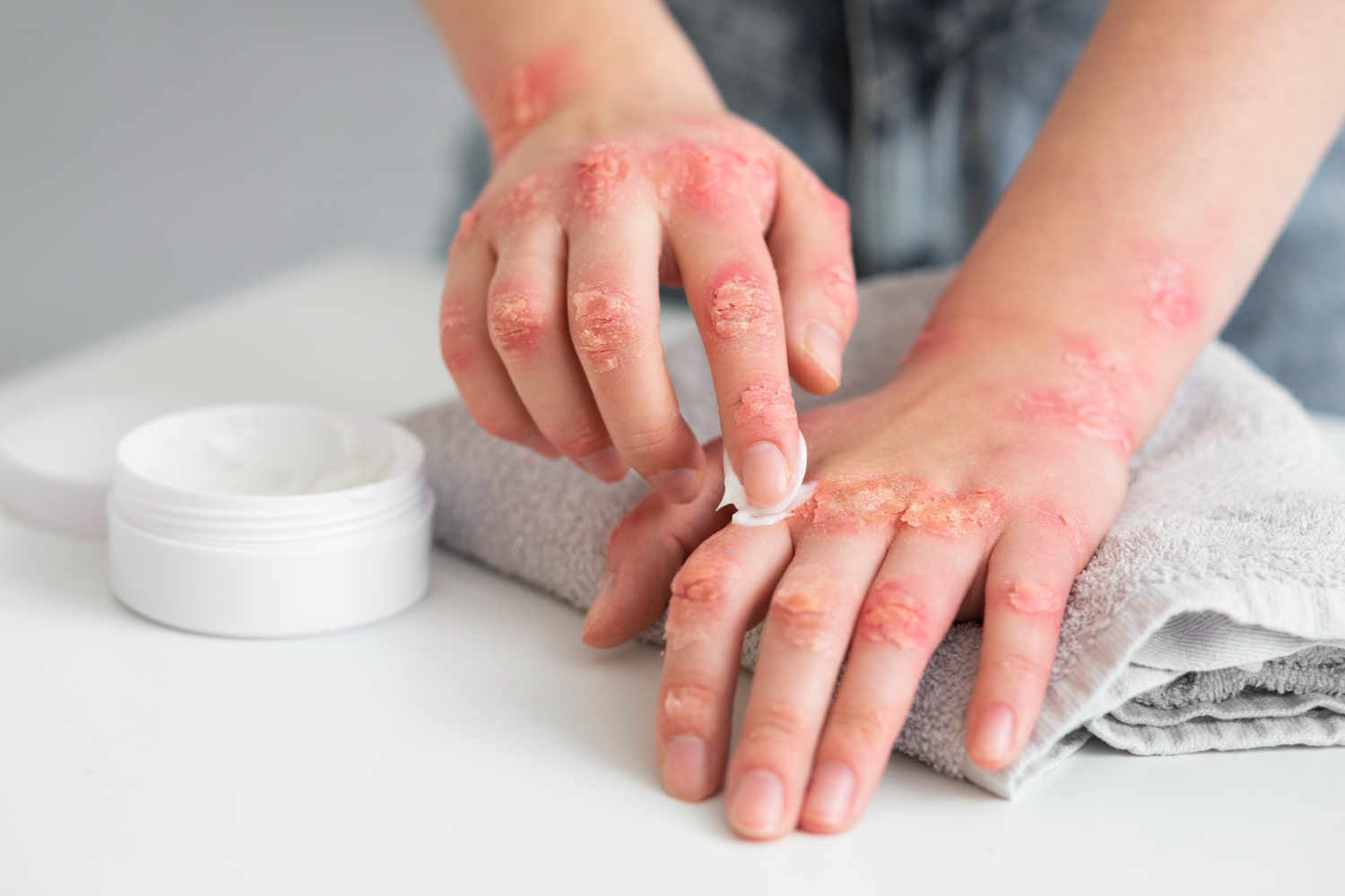 Article Cara Mencegah Dermatitis Atopik: Pentingnya Skincare Medis dan Salep Dokter