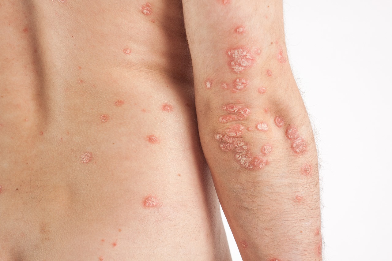Article Eksim VS Psoriasis: Kenali Perbedaannya Untuk  Temukan Solusi Perawatan Terbaik