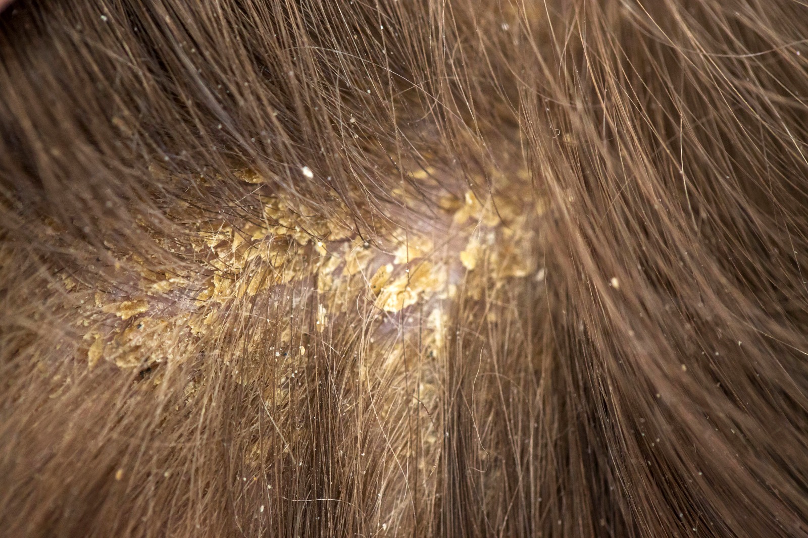 Article Kenal Lebih Jauh Dermatitis Seboroik, Penyakit Kulit Yang Sering Dianggap Ketombe Biasa