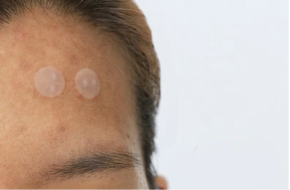 Article Rahasia Mengejutkan Di Balik Penggunaan Acne Patch: Efek Samping Yang Dapat Memperparah Jerawat