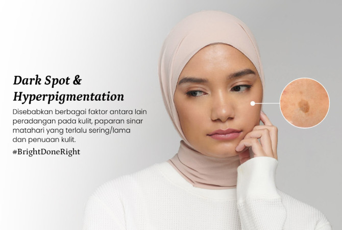 Article Jenis-Jenis Dark Spot Beserta Cara Penanganannya