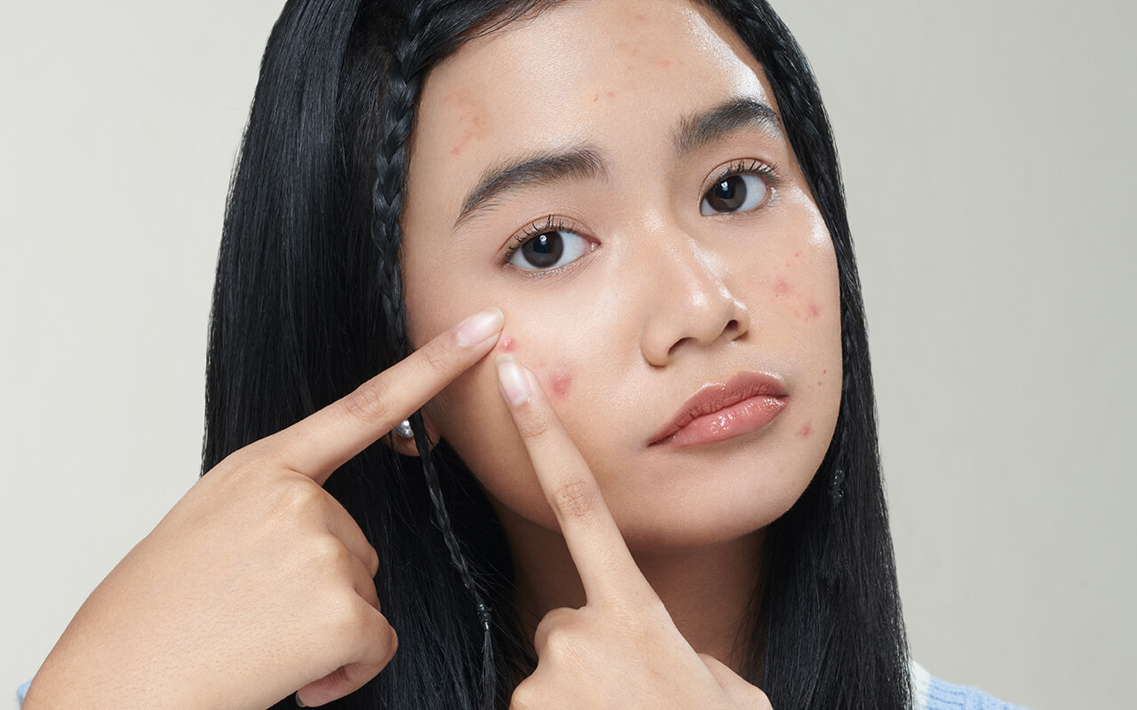 Article Wujudkan #HappyAcneEnding dengan Acne Center dari ERHA Ultimate