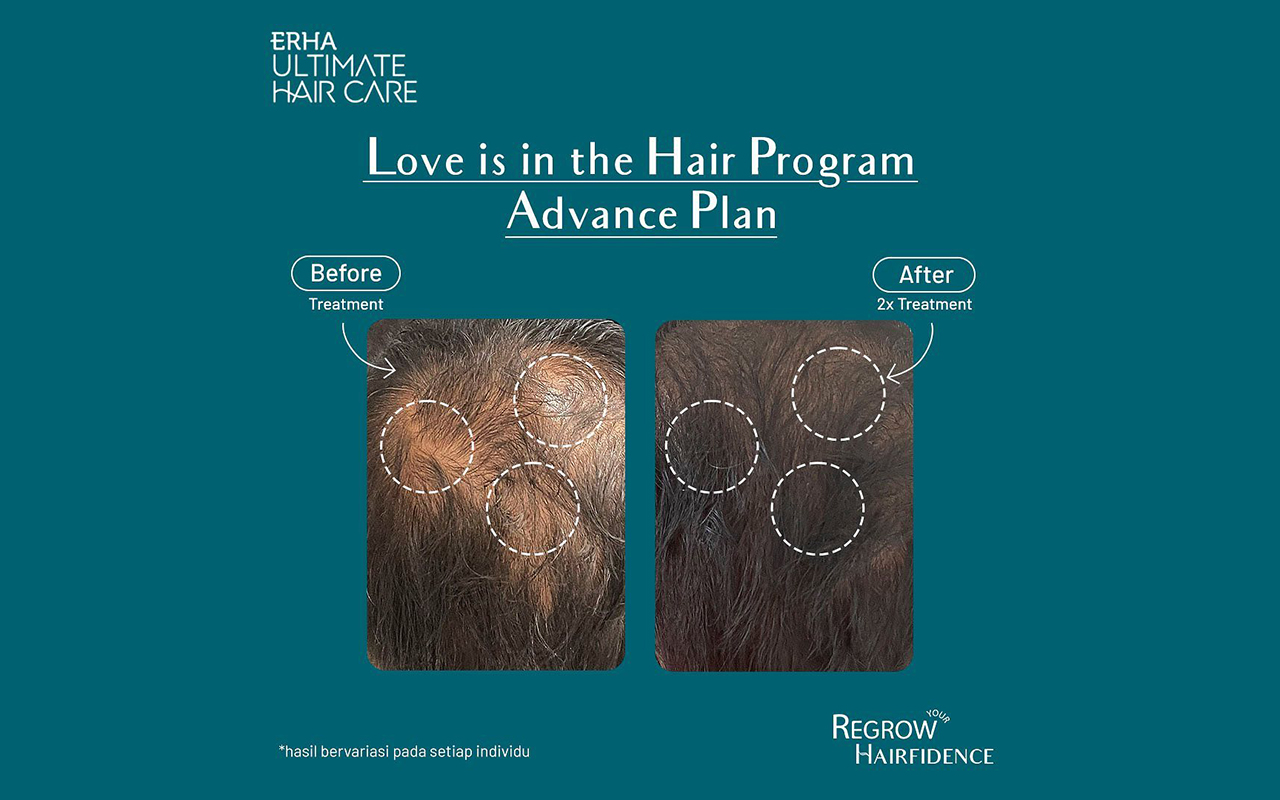 Article 5 Kebiasaan Buruk yang Bikin Rambut Tipis