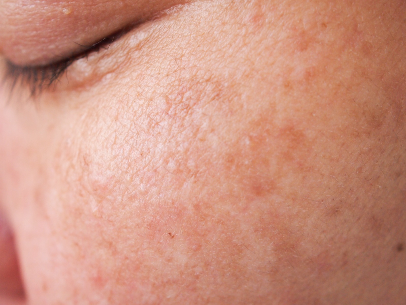 Article Melasma Rebound? Mengapa Flek Hitam Sering Kambuh dan Strategi Tepat ERHA untuk Mencegahnya