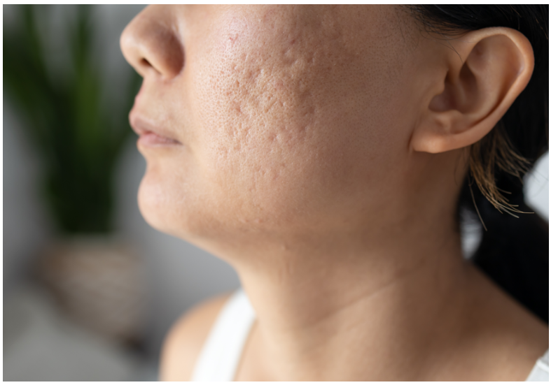 Article Bopeng Bekas Jerawat Bisa Dihilangkan? Bagaimana Caranya?