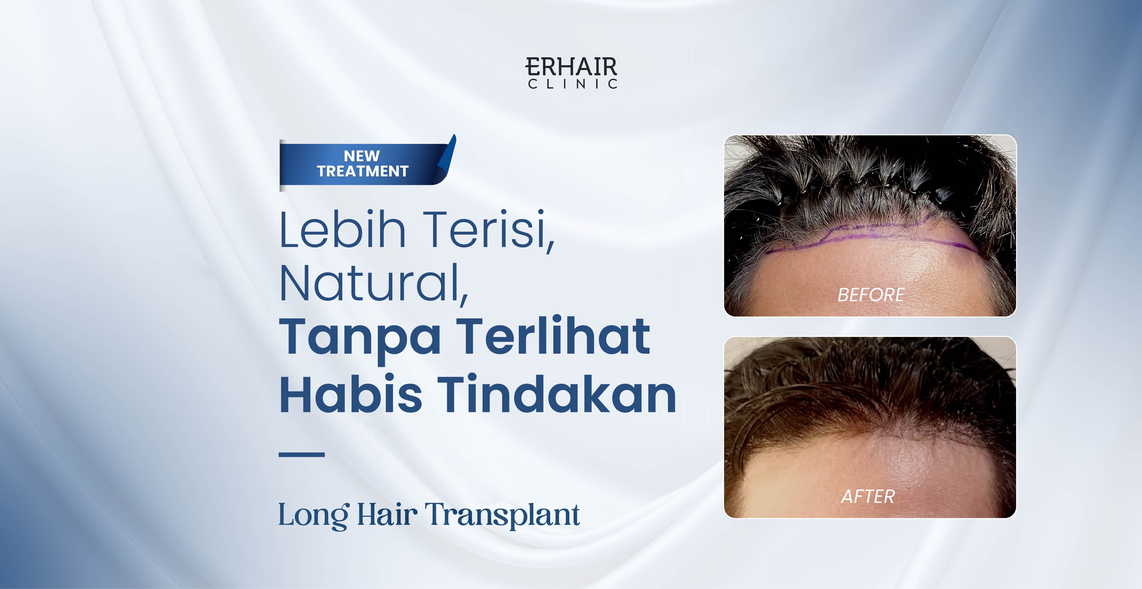 long hair transplant