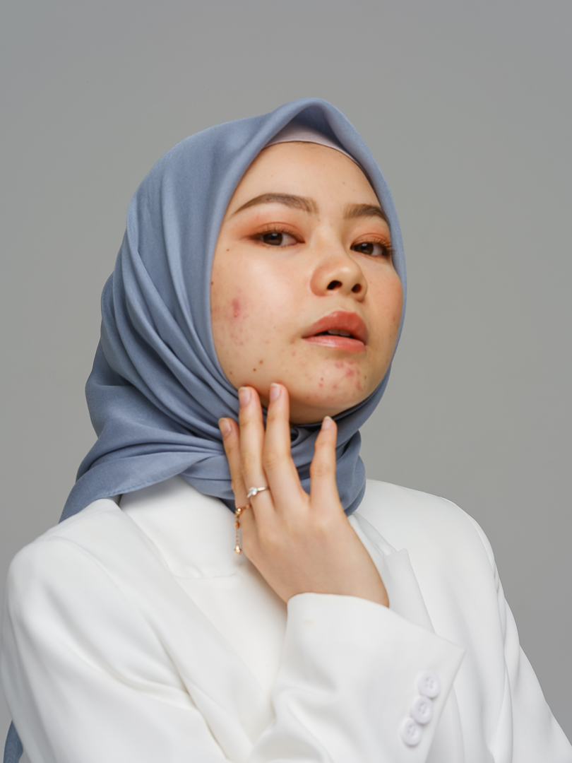 Article Stop Percaya Mitos! Fakta Seputar Jerawat yang Wajib Kamu Tahu