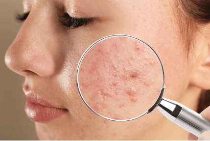 Article Cara Membedakan Jerawat Pie Dan Pih:  Kenali Acne Peeling Treatment Untuk Kulit Mulus Sempurna
