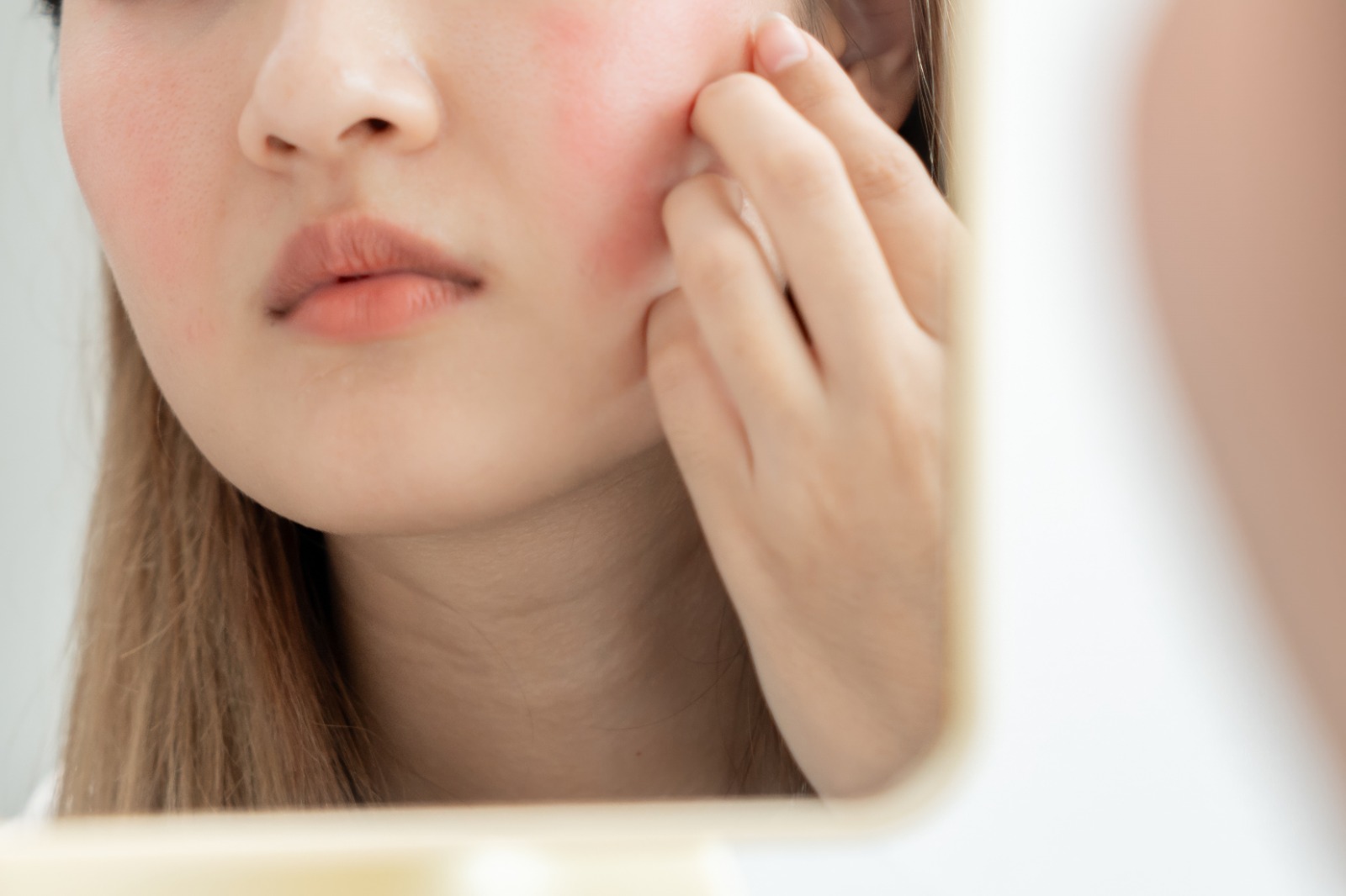 Article Hilangkan Acne Scar dengan Ultimate Skin Restoration by Rejuran Healer, Yuk Coba!