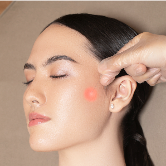 ENDOLIFT