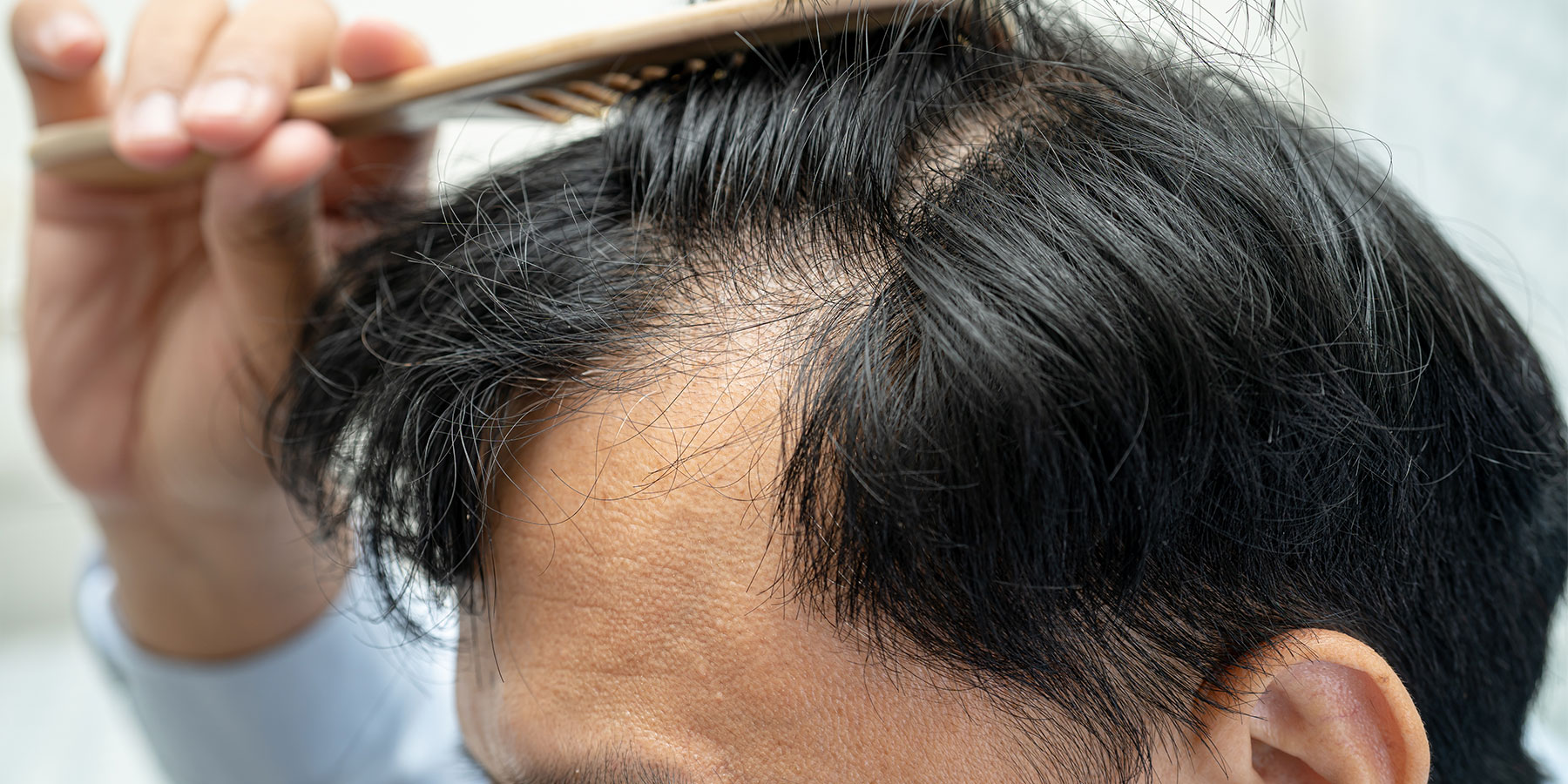 Article BotakMeter: Cek Kondisi Rambutmu Sebelum Makin Parah