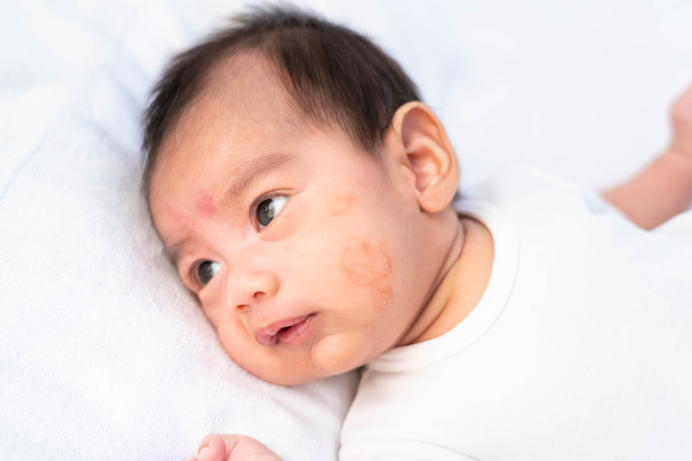 Article Eksim pada Anak Bikin Kulit Kering dan Gatal? Simak Cara Jitu Mengatasinya!
