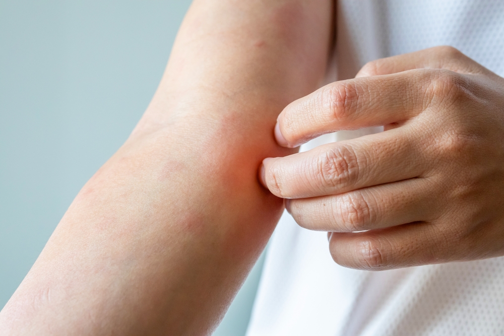 Article Kulit Gatal Tak Kunjung Usai? Ketahui Gejala Eksim dan Cara Mengatasinya