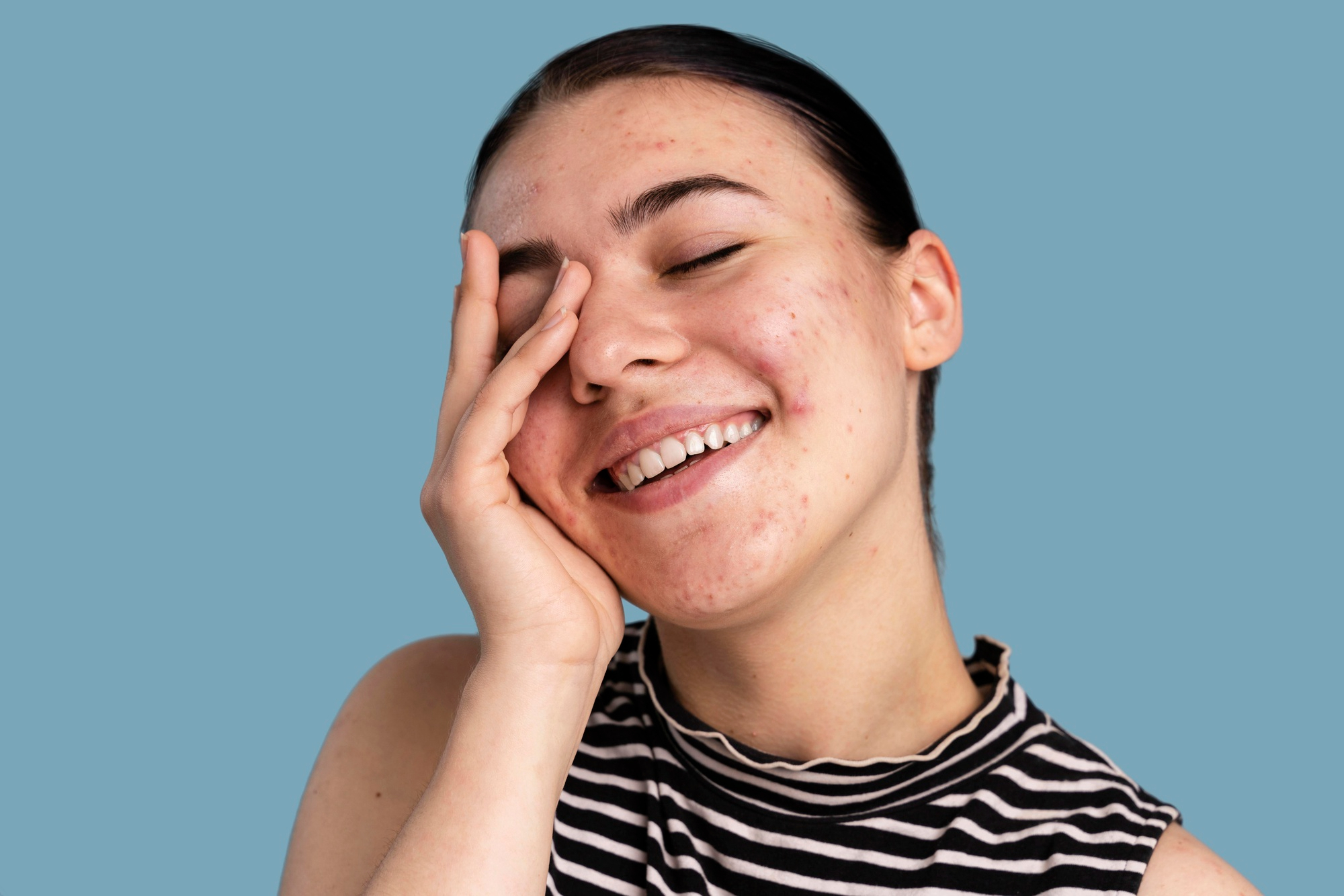 Article Sudah Pakai Skincare, Jerawat Aktif Tetap Muncul? Ini Penyebab dan Solusinya!