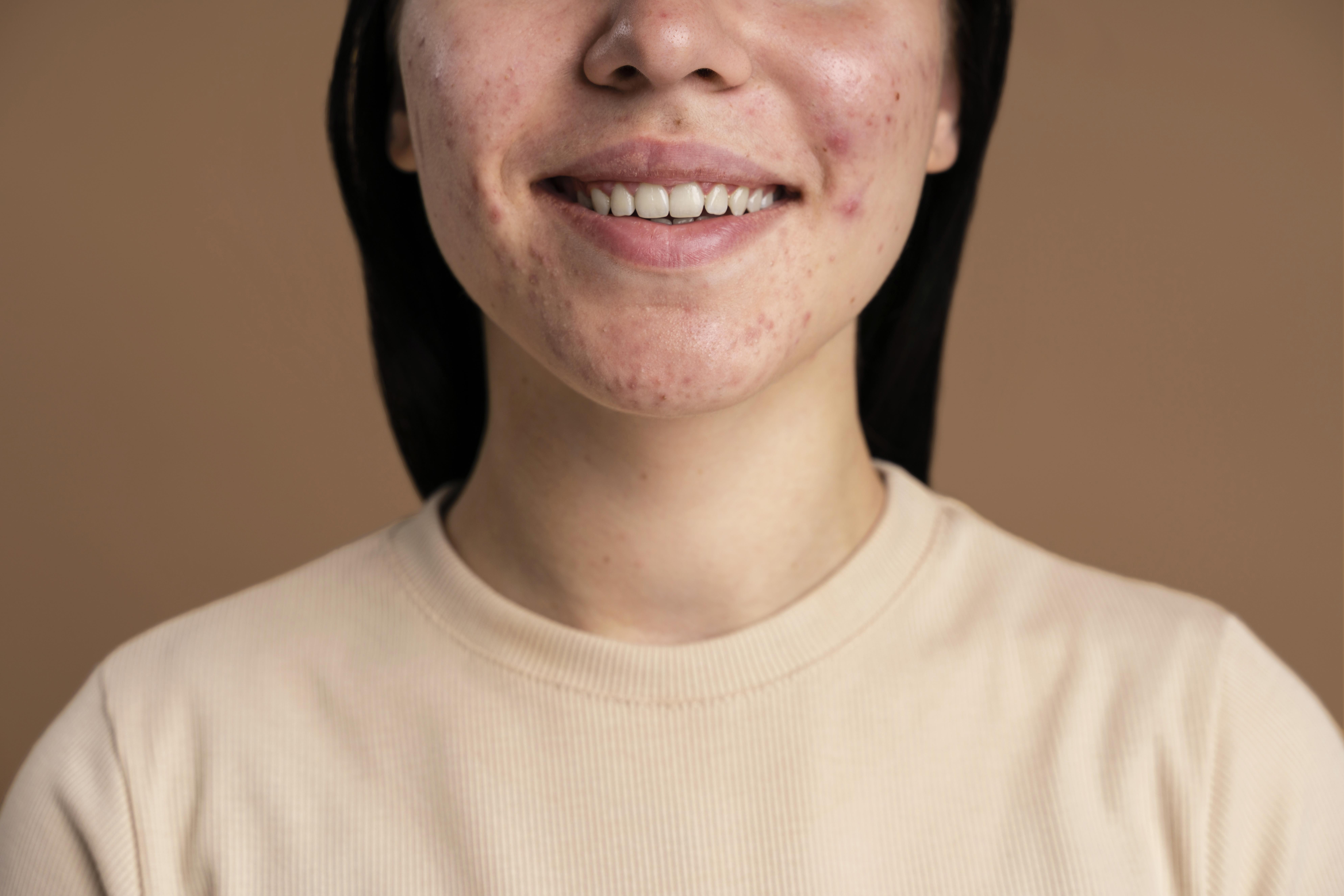 Article Stop Coba Skincare Viral! Ini 7 Alasan Skincare Rekomendasi Dokter Lebih Ampuh untuk Jerawat!