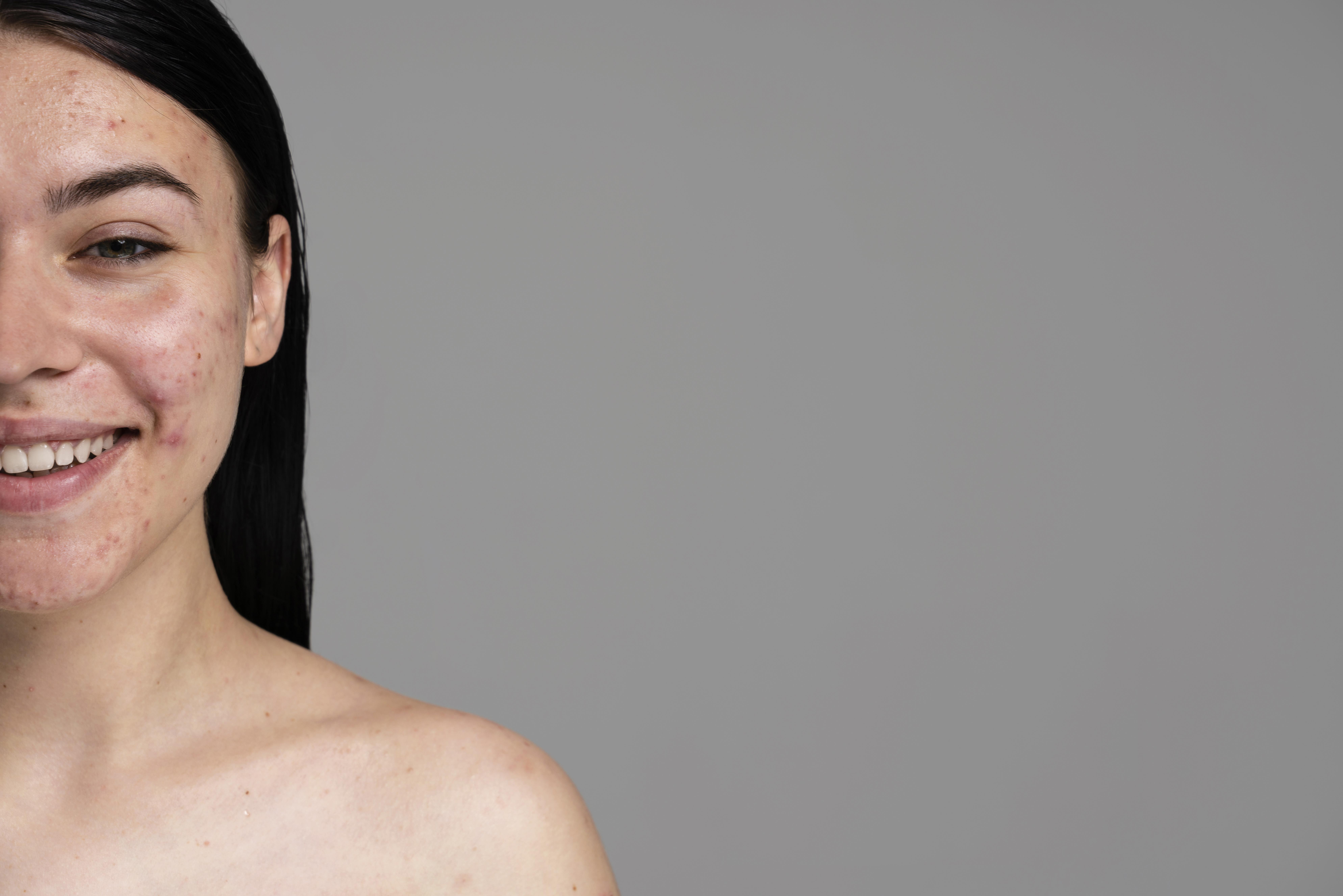 Article Skincare Tidak Cukup? Coba Treatment Laser Bekas Jerawat: Proses, Jenis, Harga, & Hasilnya!