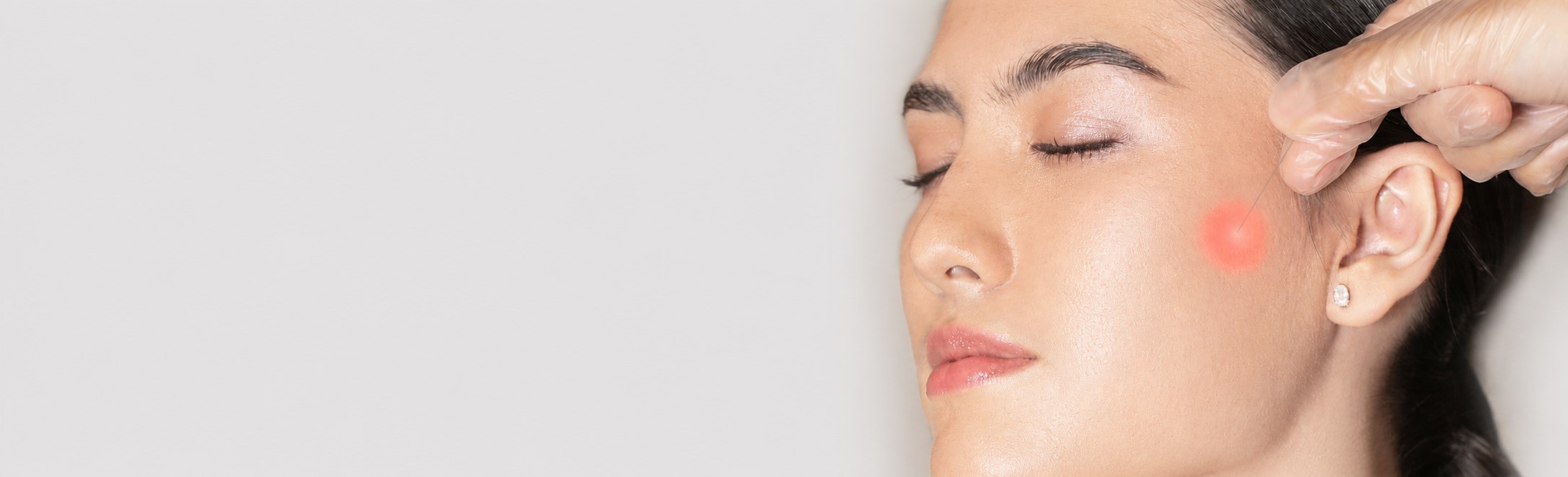 Endolift