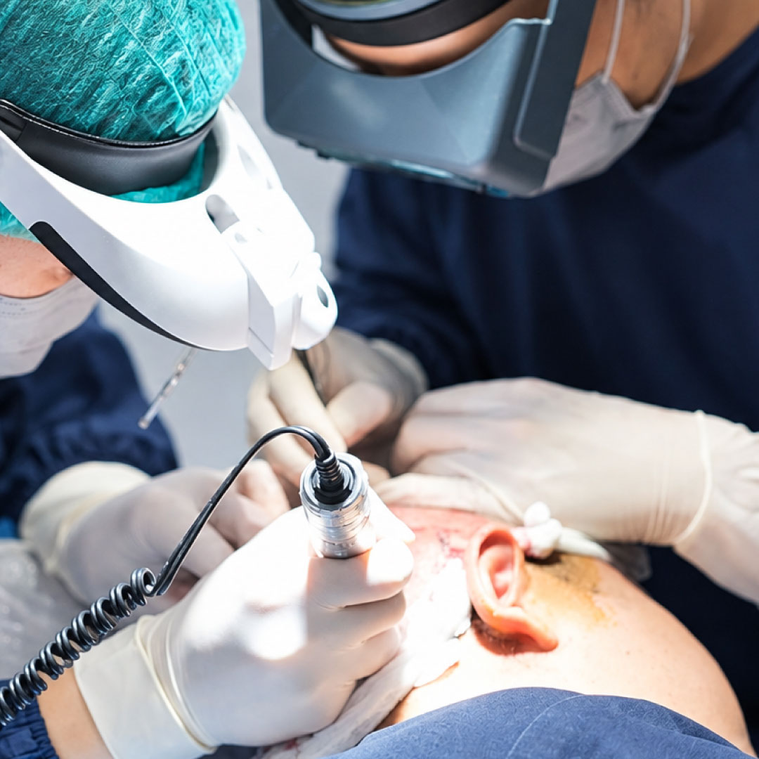 Image Hair Transplant