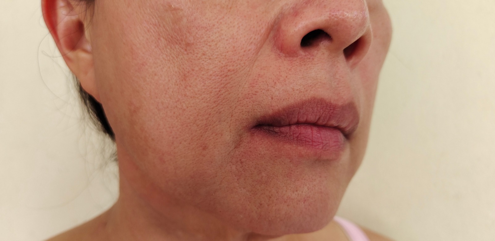 Article Transformasi Instan Dengan Ultimate Skin Reborn  By Profhilo Sebagai Solusi Kulit Kendur