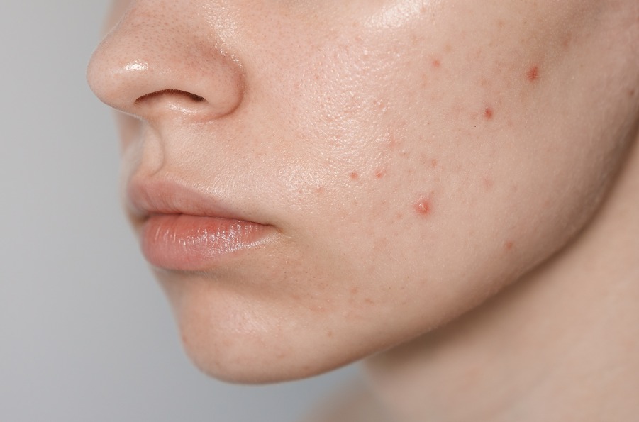 Article Jangan Asal Pilih Skincare, Ini Cara Efektif Atasi Jerawat dan Bekasnya